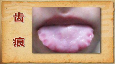 齿痕舌图片（舌头上有齿痕）
